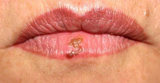 herpes genital symptoms. herpes genital.