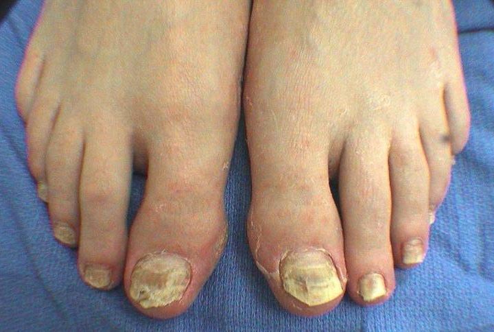 Bad Toenails